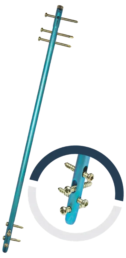 HBFC® — Haste Diafisária de Fêmur