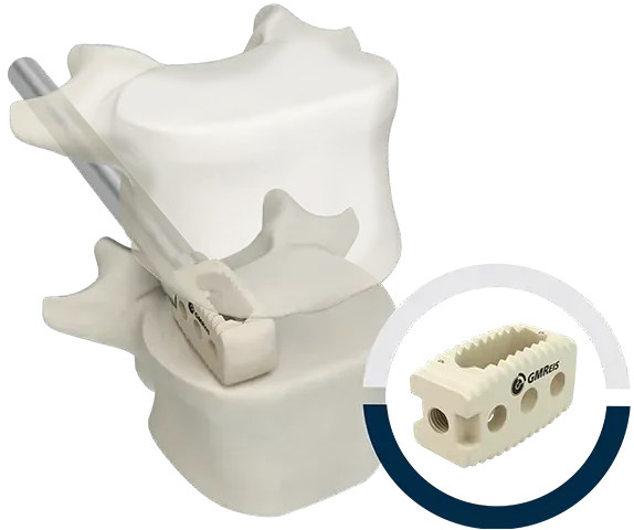 Plifix® PEEK